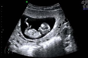 fetus 1