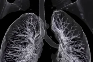 virtual bronchoscopy 1